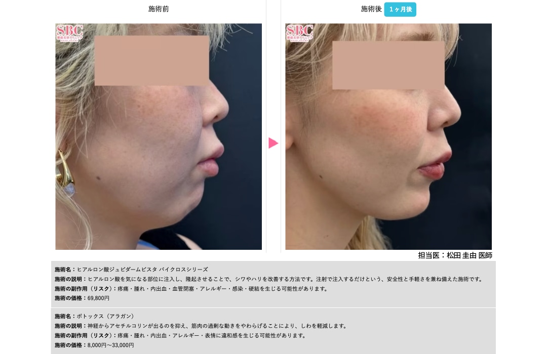 ジュビダーム ボラックス｜ボリュームアップと長期持続に優れた製剤