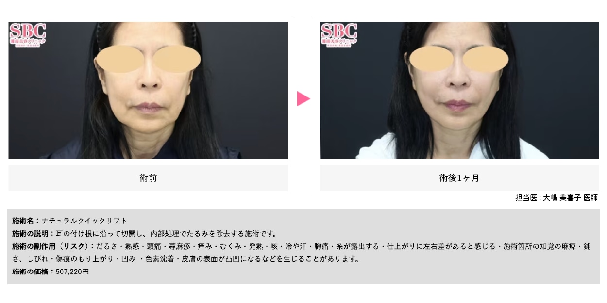 ナチュラルクイックリフト