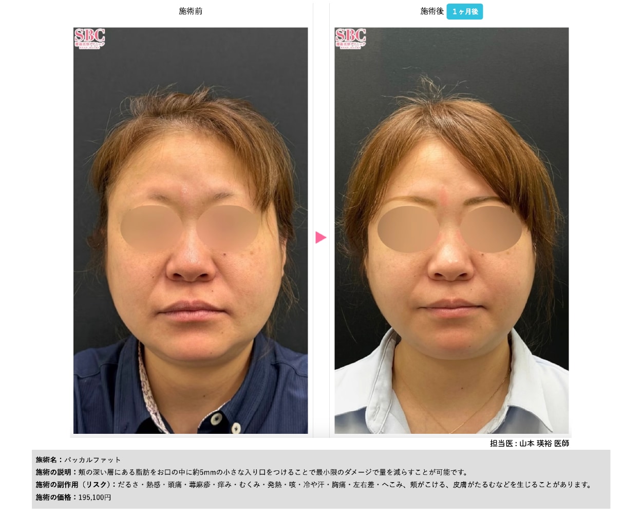 バッカルファット