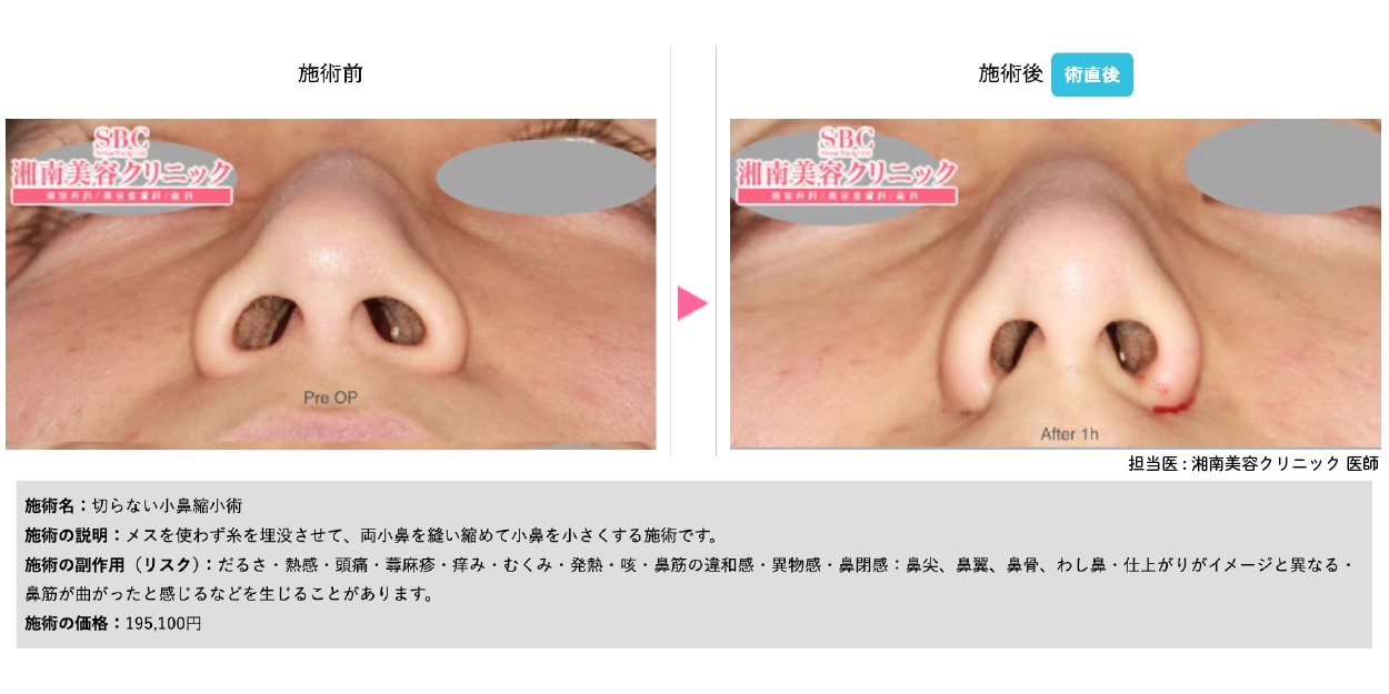 切らない小鼻縮小術
