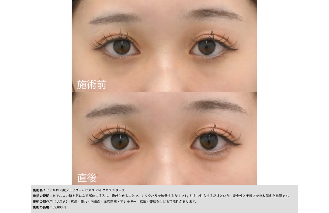 ジュビダーム ボルベラ|唇や目元に適した自然な仕上がり