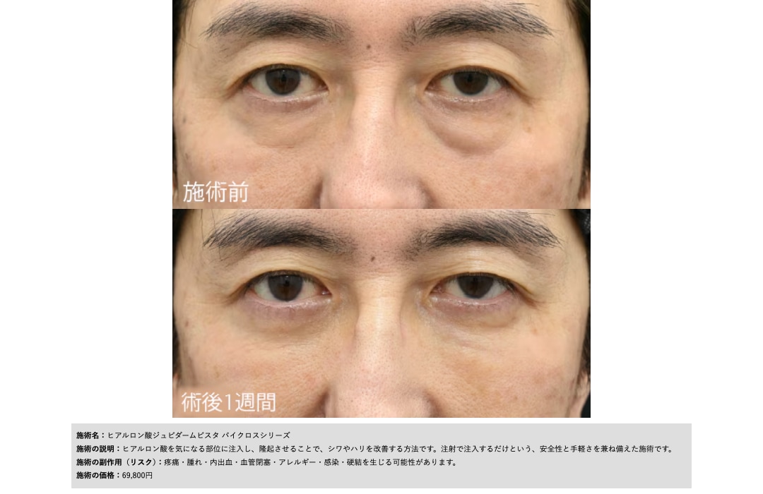ジュビダーム ボリューマ|リフトアップ効果や持続期間