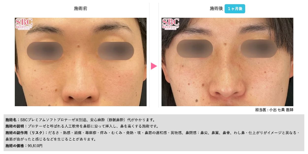 SBCプレミアムソフトプロテーゼ