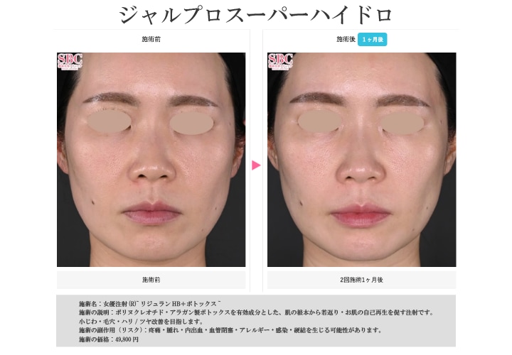 ジャルプロスーパーハイドロ／症例写真