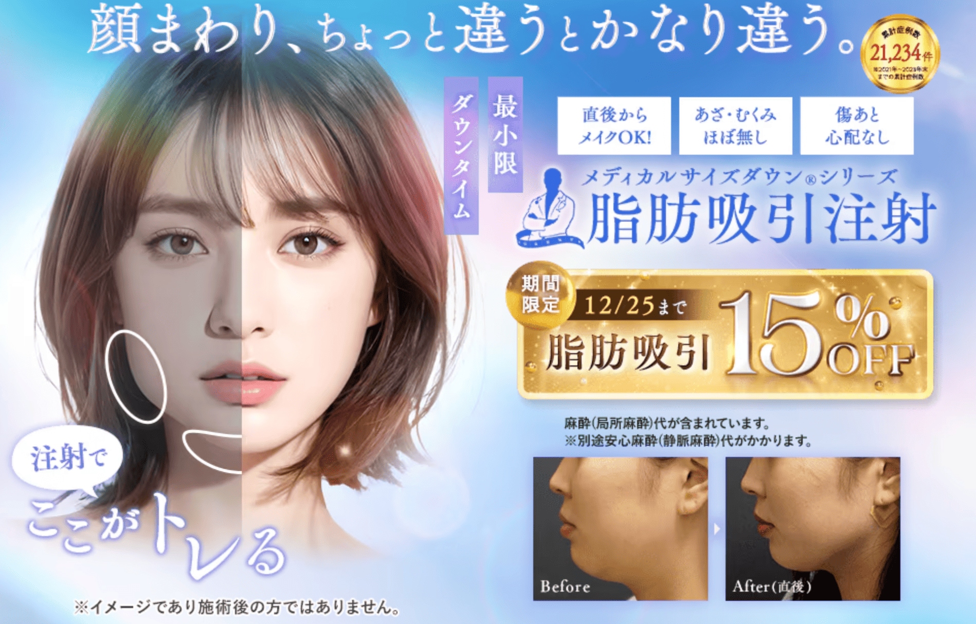 ▶︎脂肪吸引注射