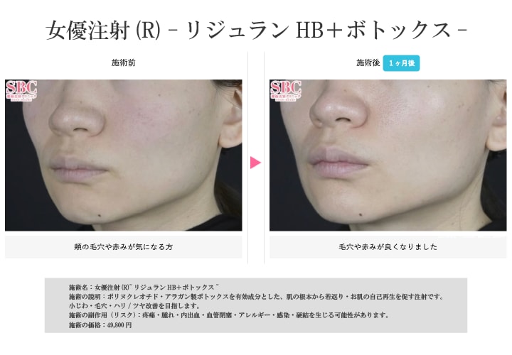 女優注射／症例写真