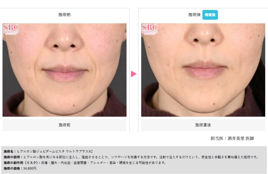 ヒアルロン酸 症例