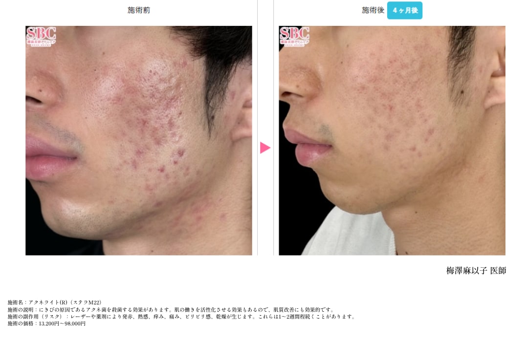 ■アクネライト