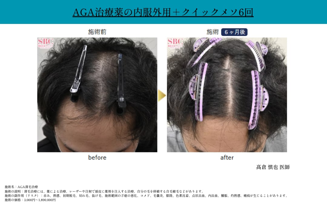 ■薄毛治療