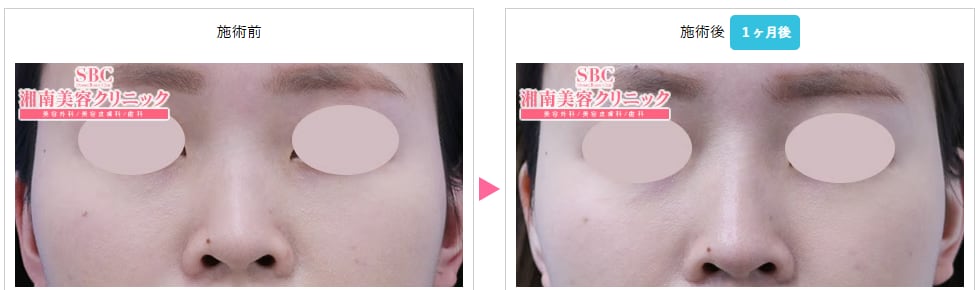 ヒアルロン酸