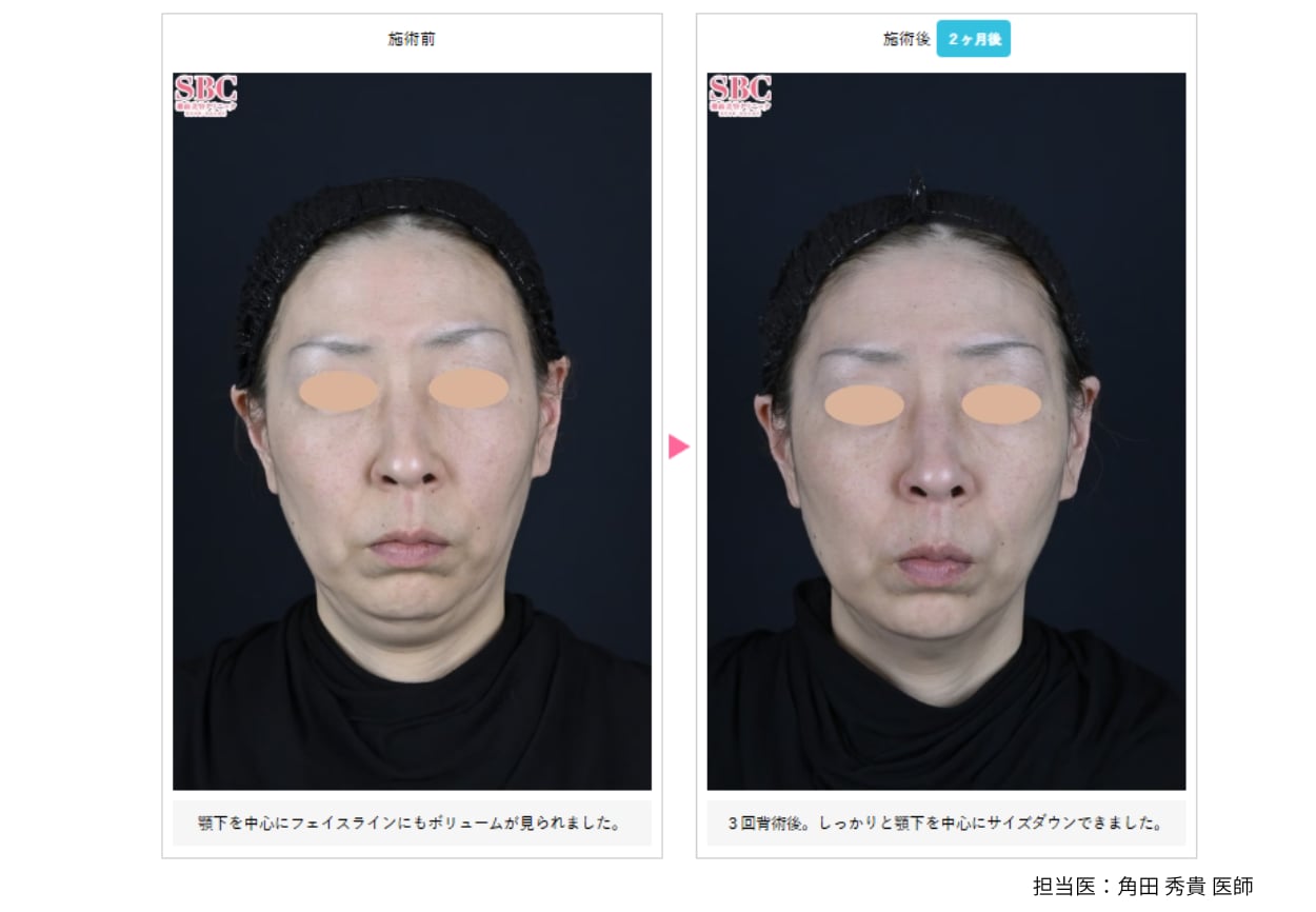 脂肪溶解ハイフ症例