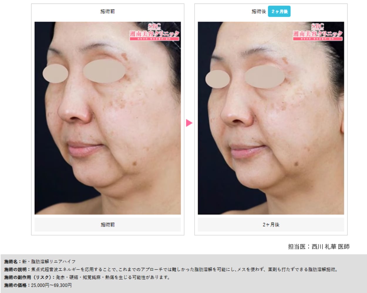 脂肪溶解ハイフ症例