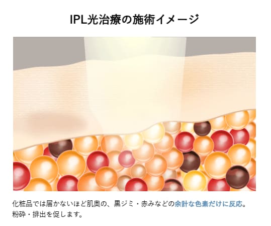 IPL光治療とは？<br />
シミ・くすみ・赤みにアプローチする人気の美肌治療