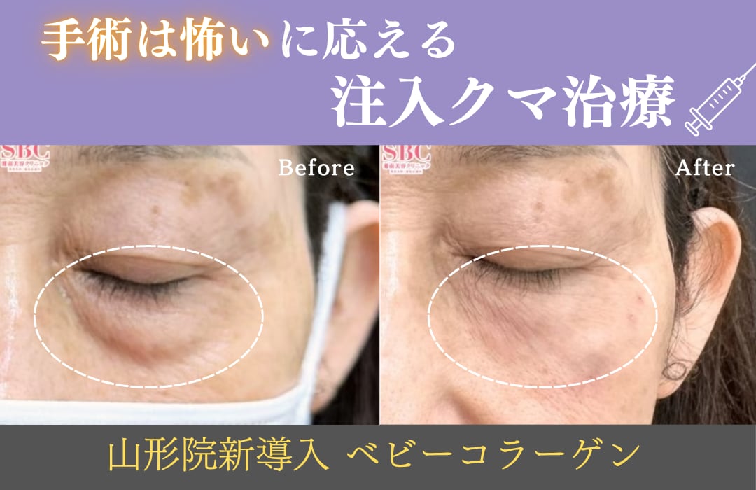 赤ちゃんのようなハリを呼び覚ます「ベビーコラーゲン」|目の下のクマ・小じわを根本から解決する次世代の肌再生治療
