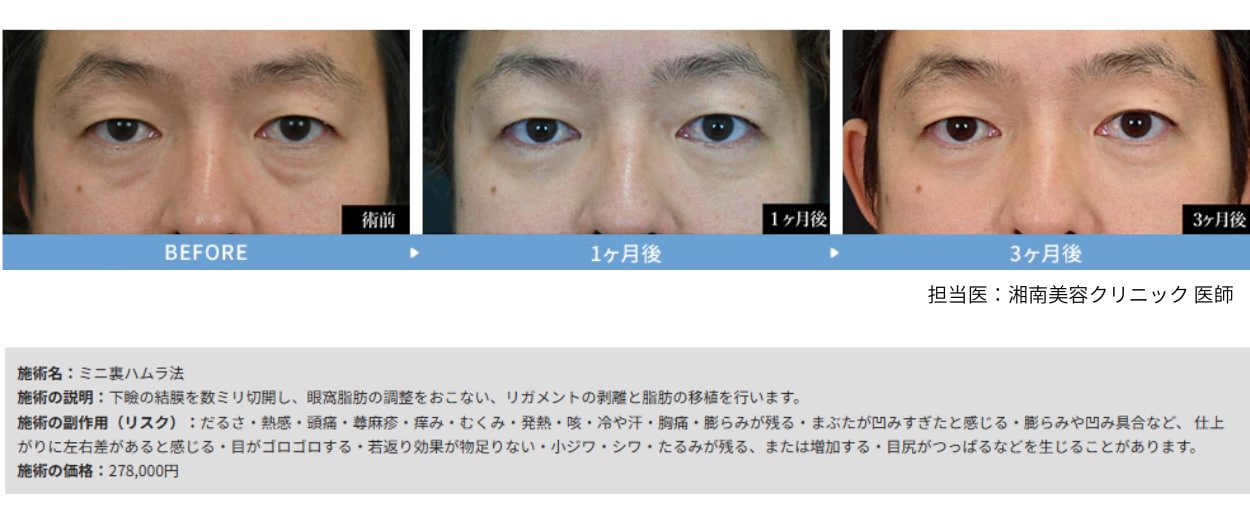 ミニ裏ハムラ