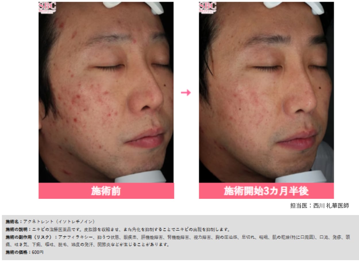 ニキビ治療薬
