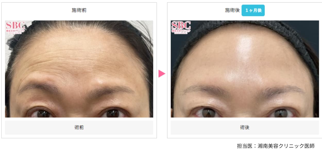 女優注射 症例写真