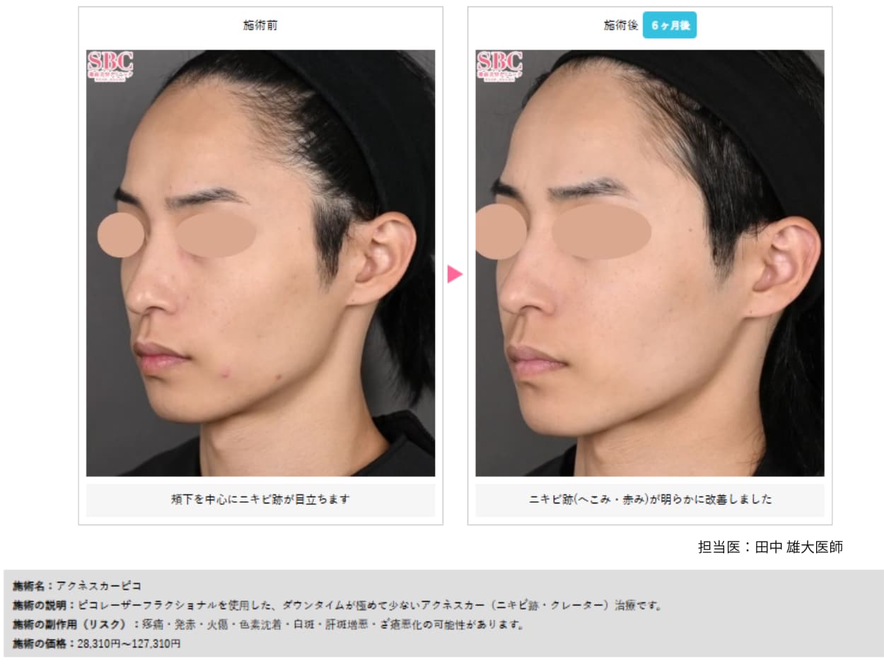 ニキビ