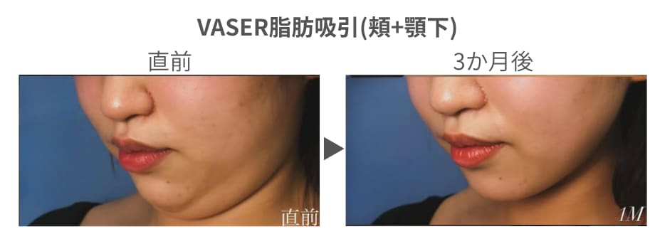 脂肪吸引
