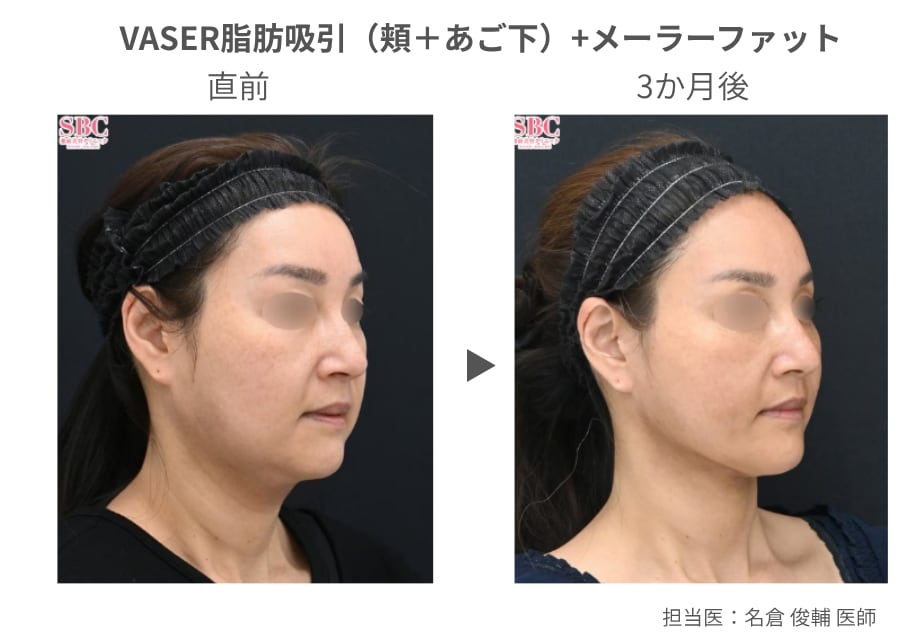 脂肪吸引