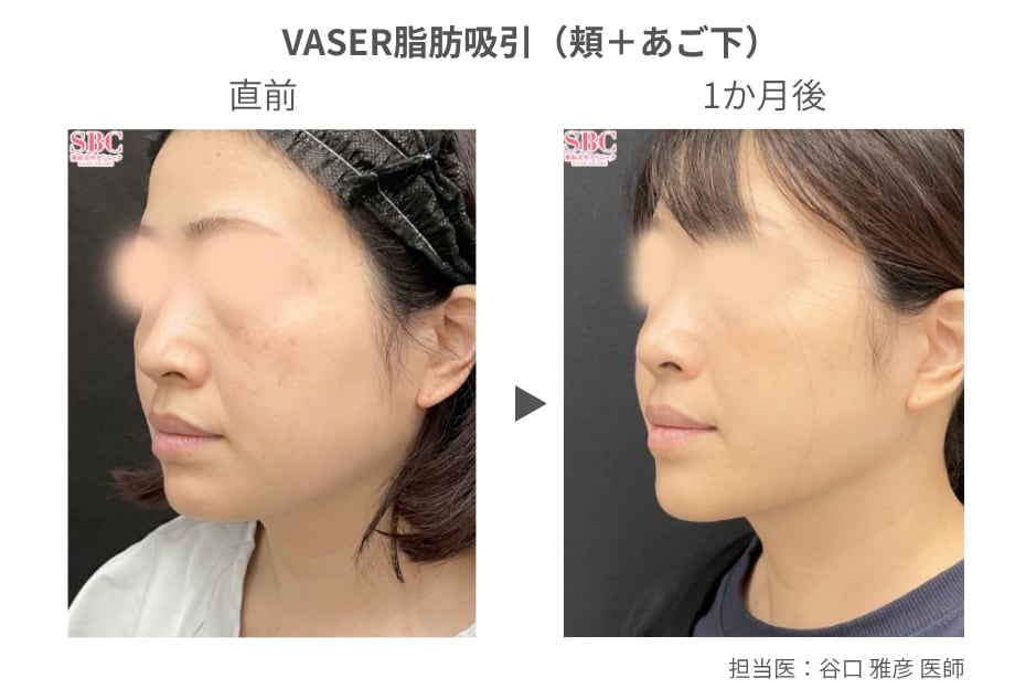 脂肪吸引