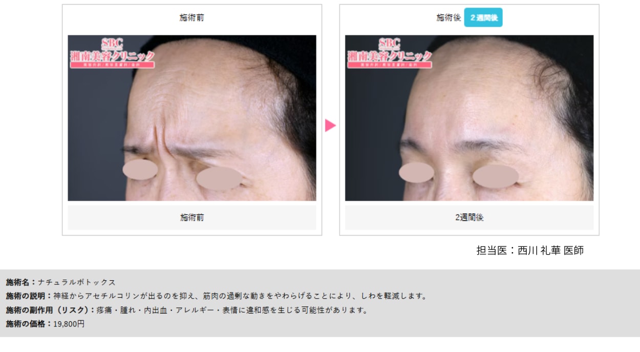 表情ジワが気になる方に｜しわ取り注射（ボトックス）🌸