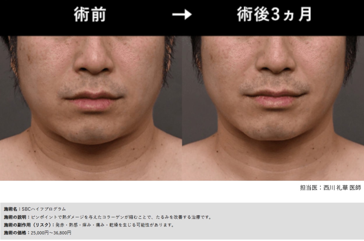 「SBCハイフプログラム」×「脂肪溶解リニアハイフ」