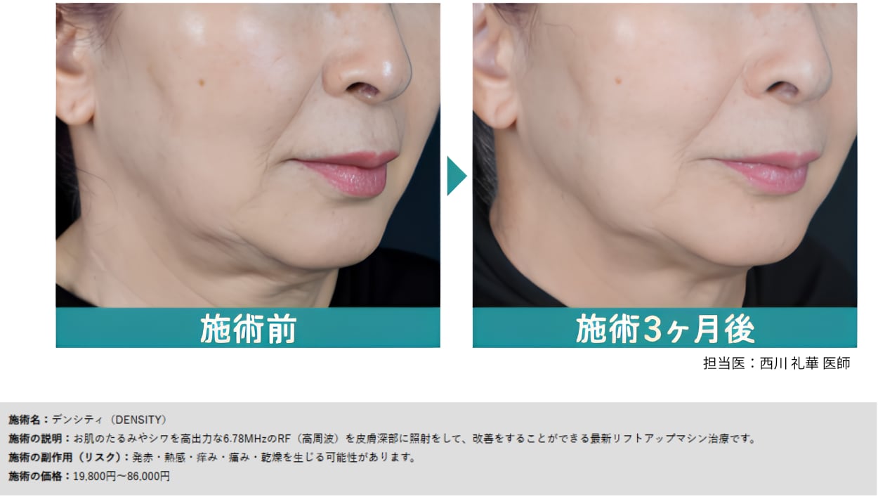 肌のハリ・たるみが気になる方に｜デンシティ✨