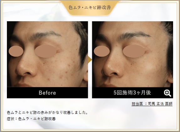 ✨毛穴の開き・ニキビ跡が気になる方