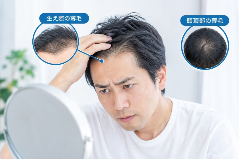 男性のAGA（男性型脱毛症）とは？👨