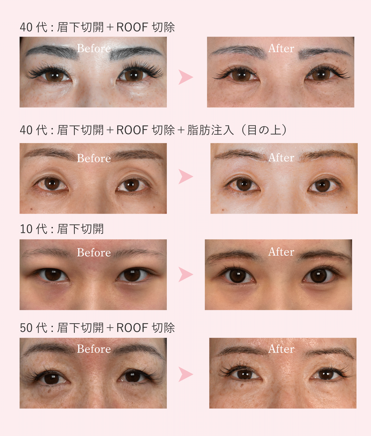 たるみのタイプによって施術方法は様々。