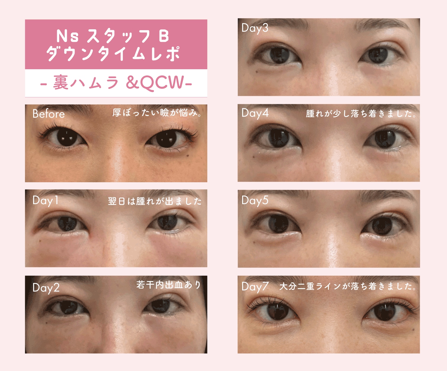 名古屋駅本院Ns:Bさんの場合