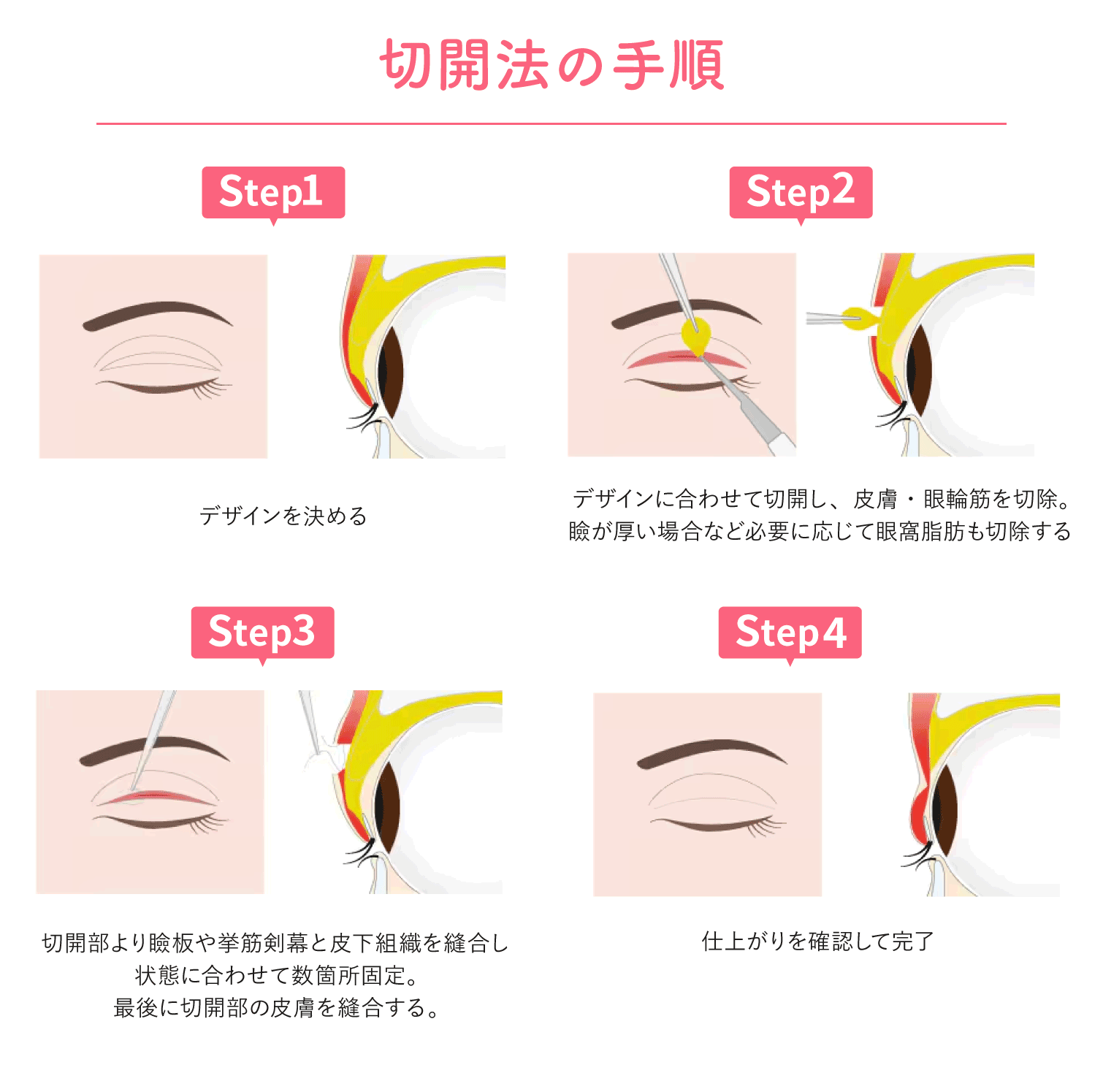 次に【切開法】