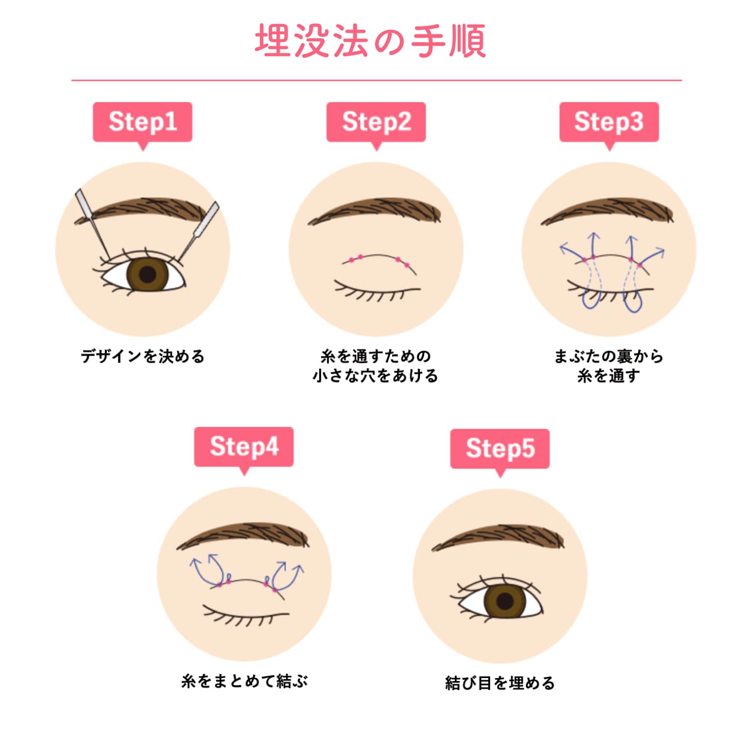 まずは【埋没法】