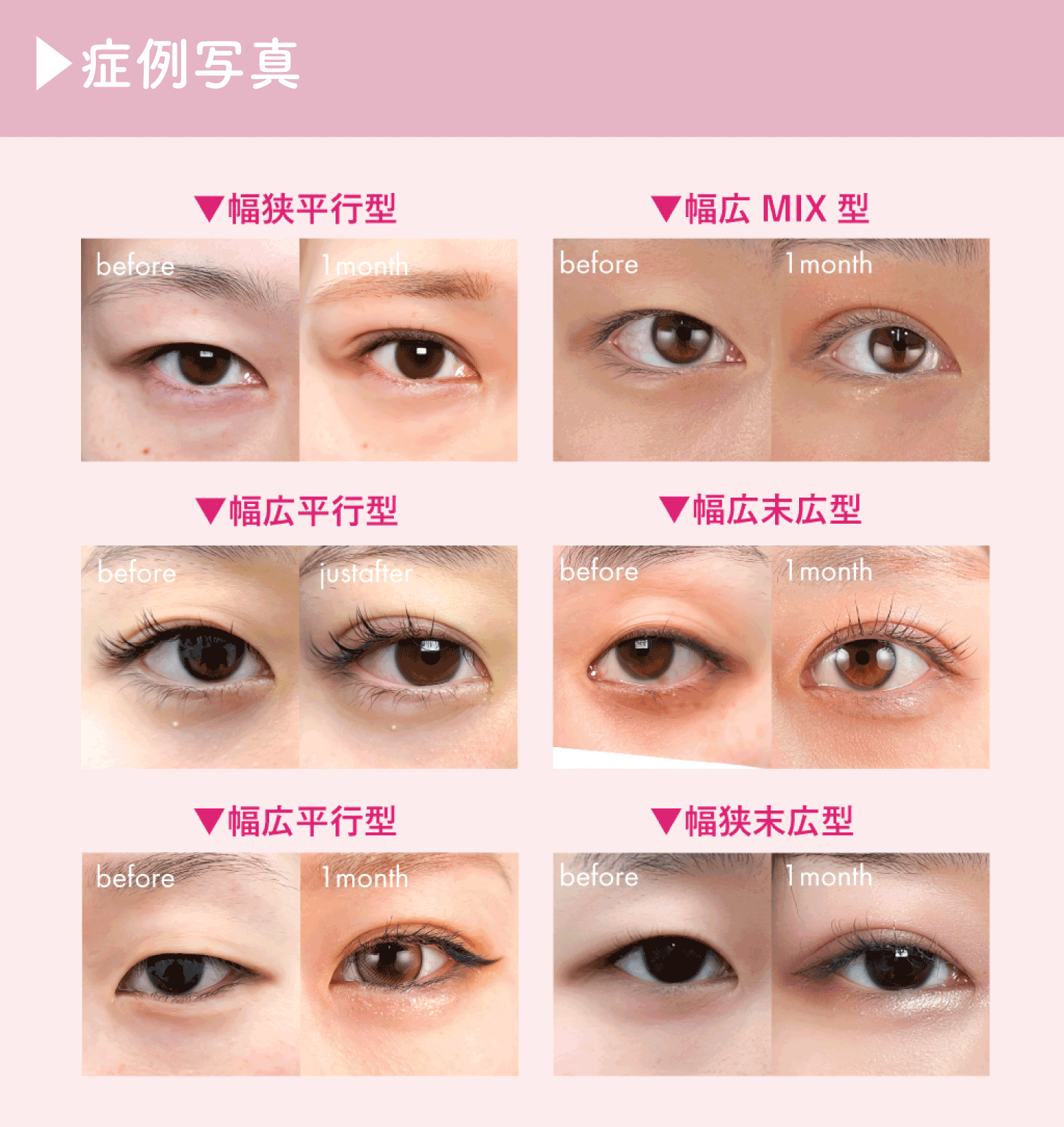 目元の状態や理想のタイプによって施術方法は様々。