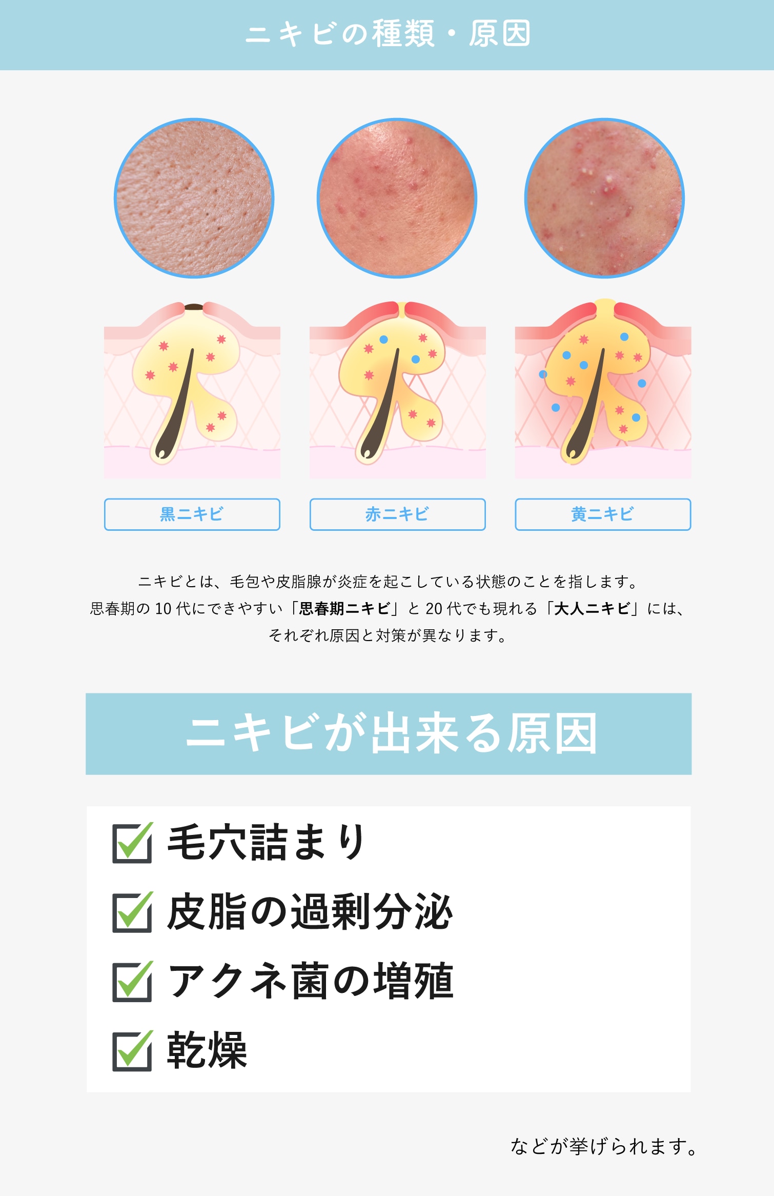 ニキビ