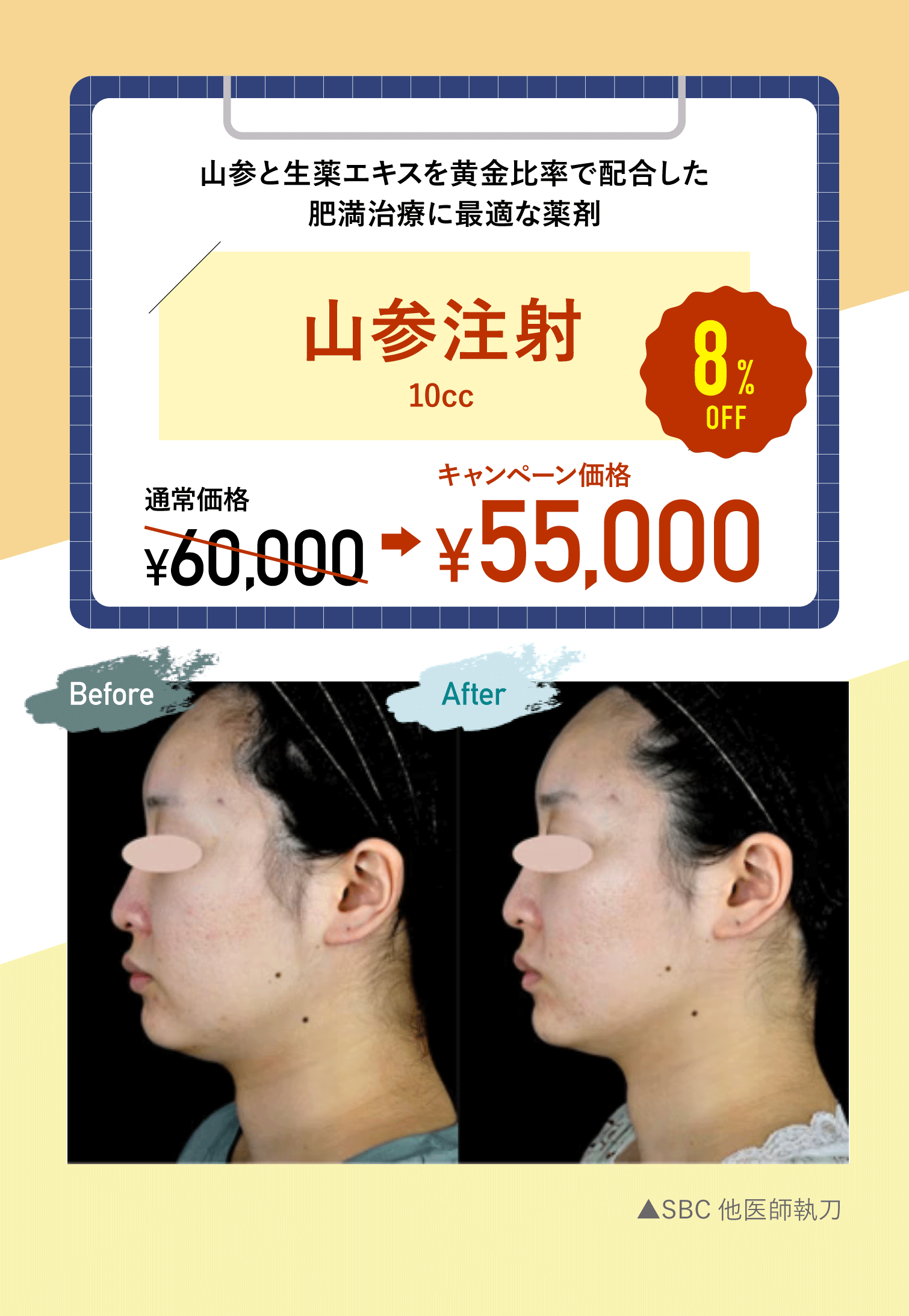 根強い人気の脂肪溶解注射、受けたことありますか?