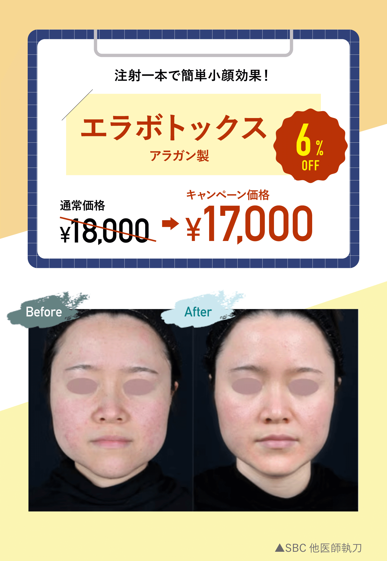 とりあえずエラボトしてみる?