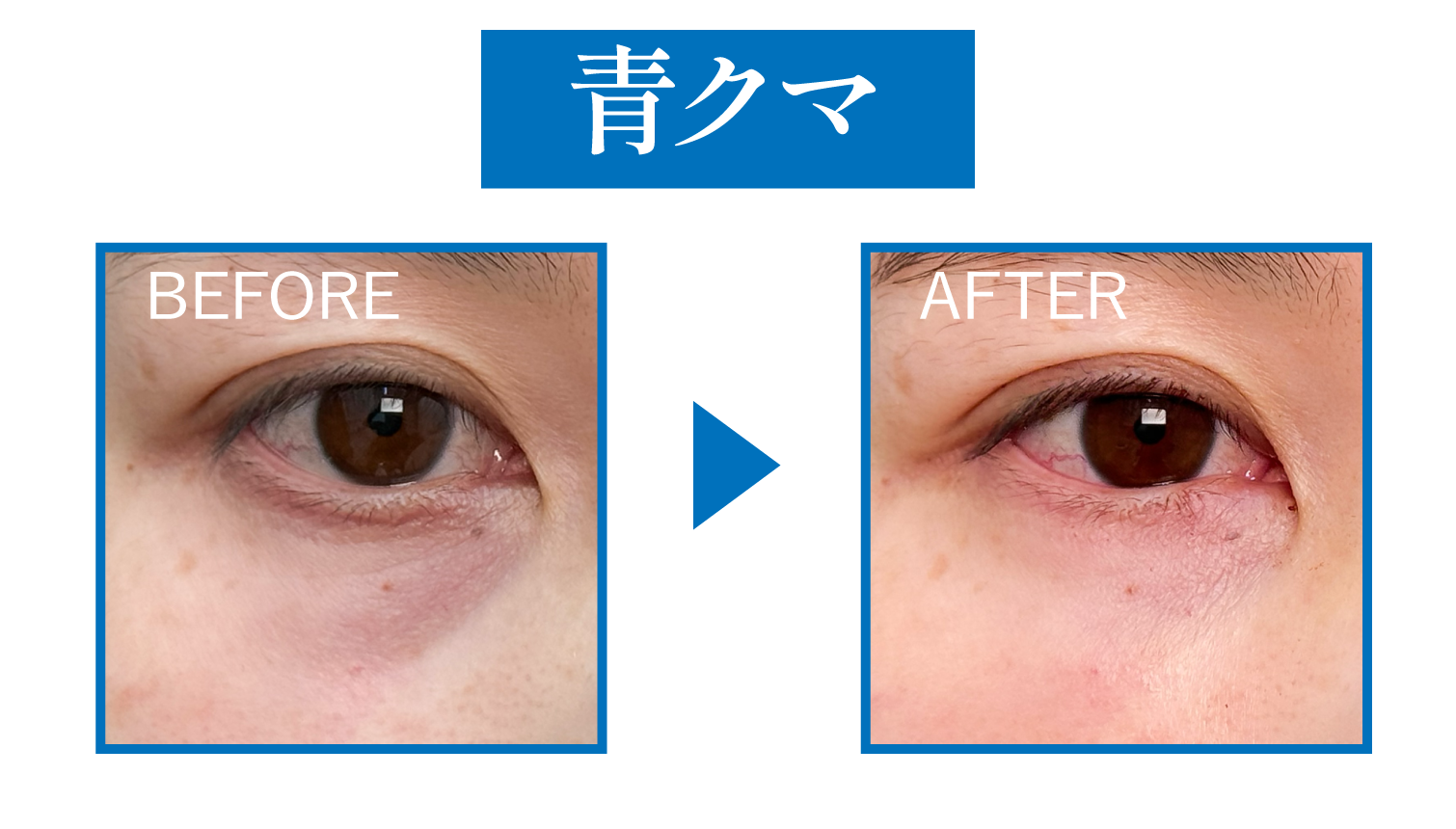 🟦青クマ|血行不良による“疲れ顔”タイプ