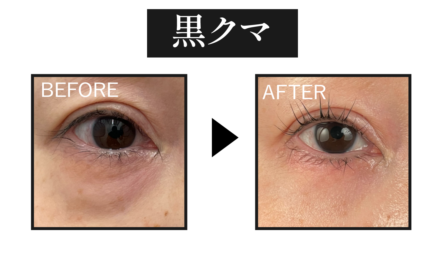 ⬛️黒クマ|たるみや影による“老け見えタイプ”