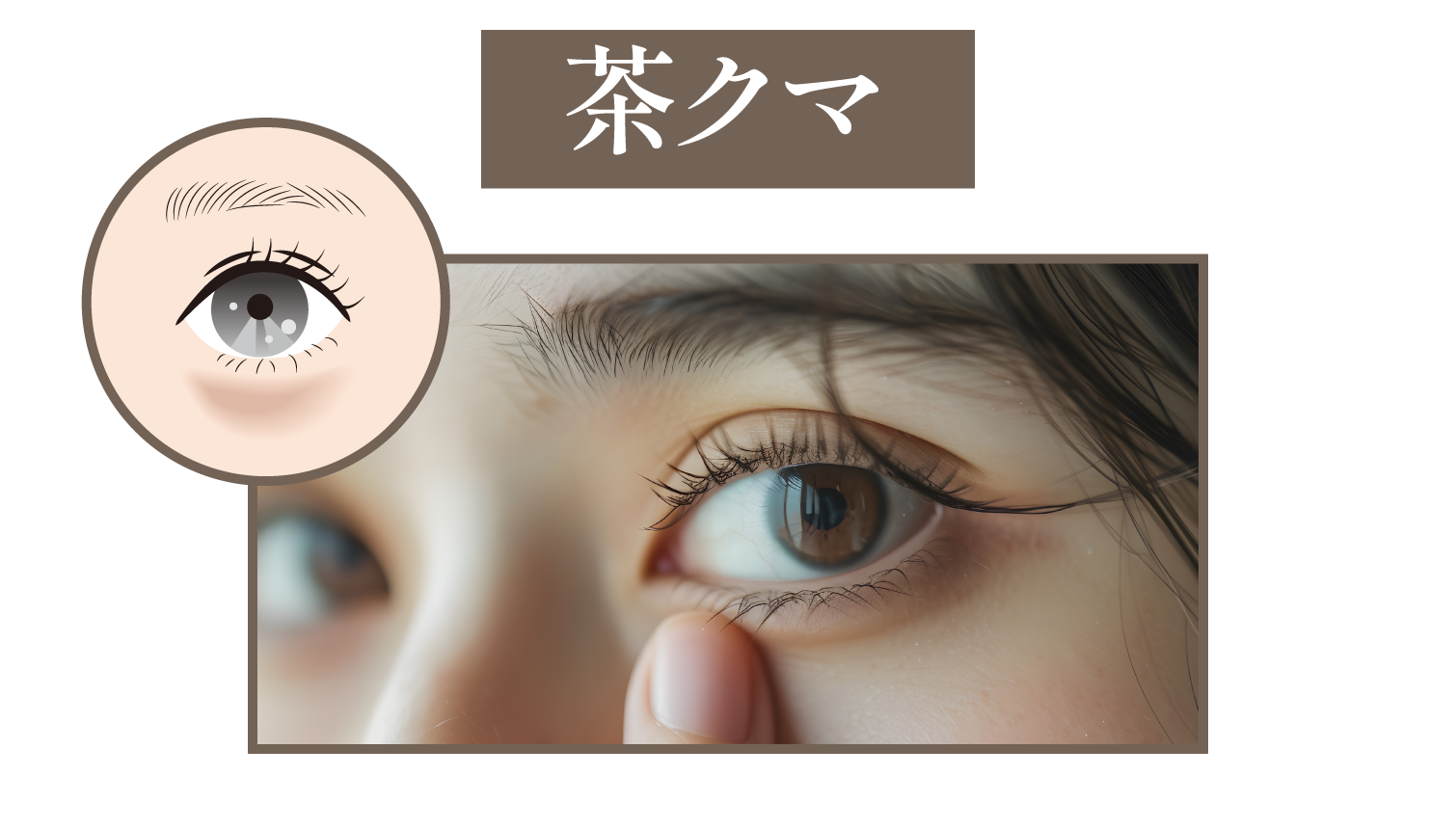 🟫茶クマ|色素沈着による“くすみタイプ”