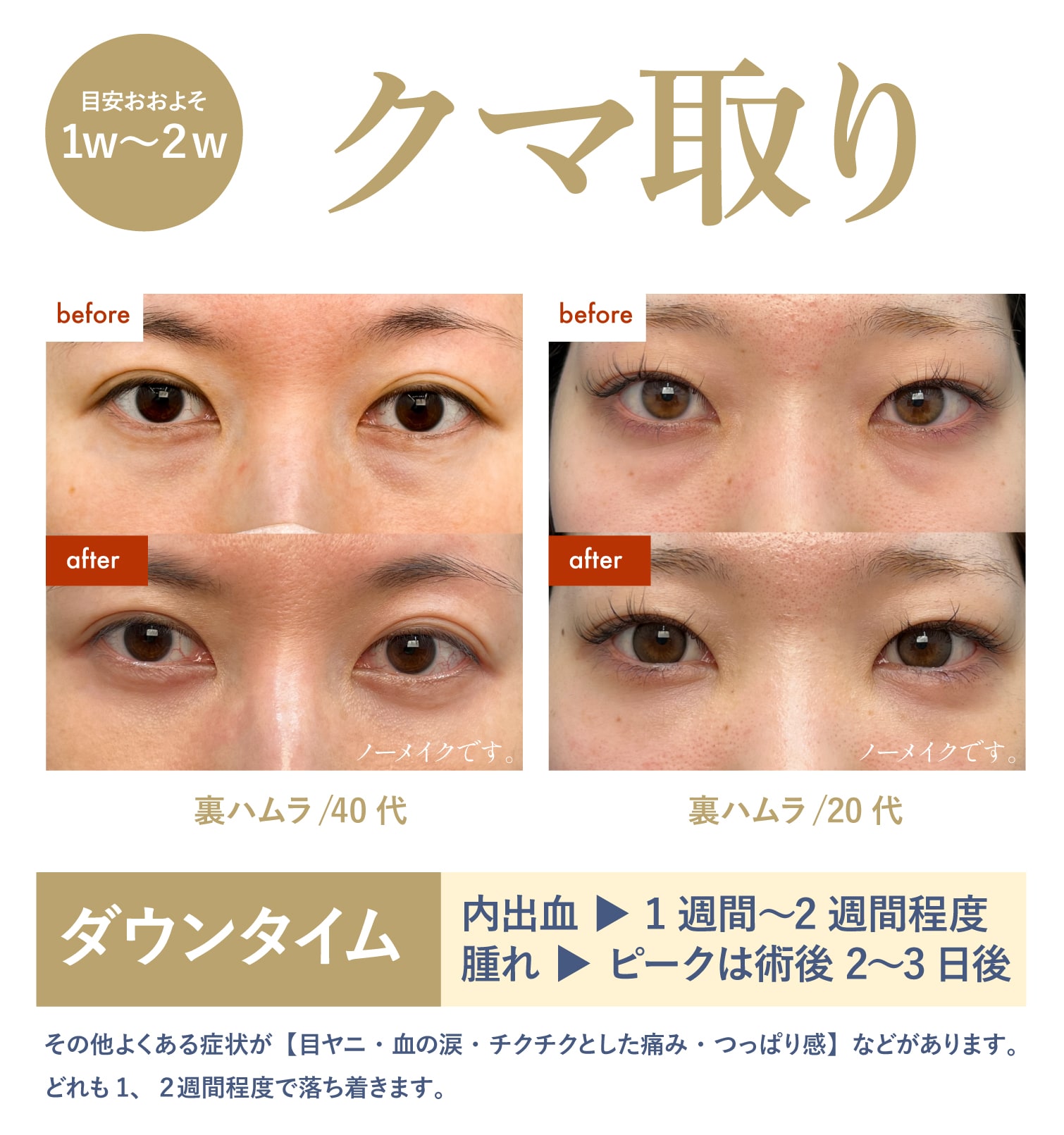 【DT1〜2週間】クマ取り