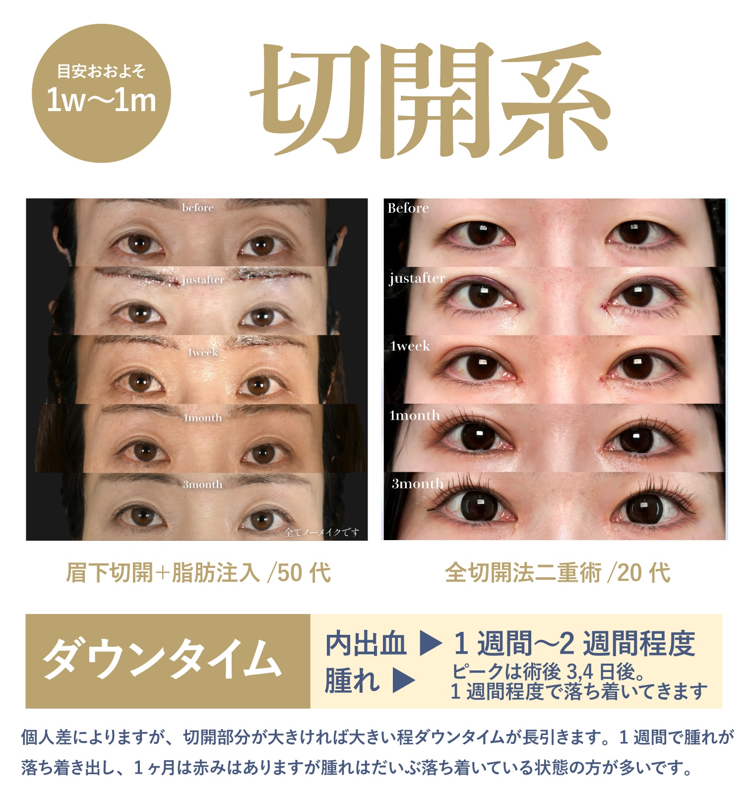 【DT1週間〜1ヶ月】切開系