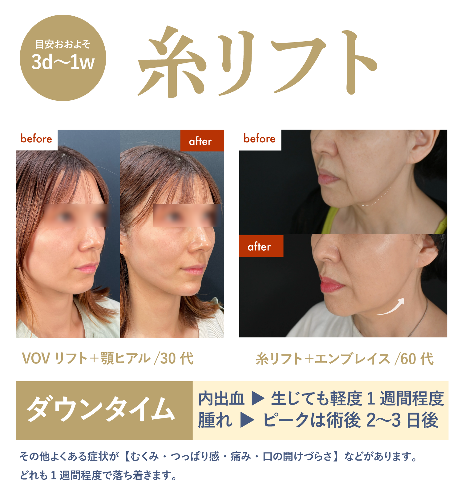 【DT数日〜1週間】糸リフト