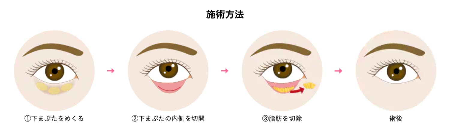 クマ取り治療の1種です。