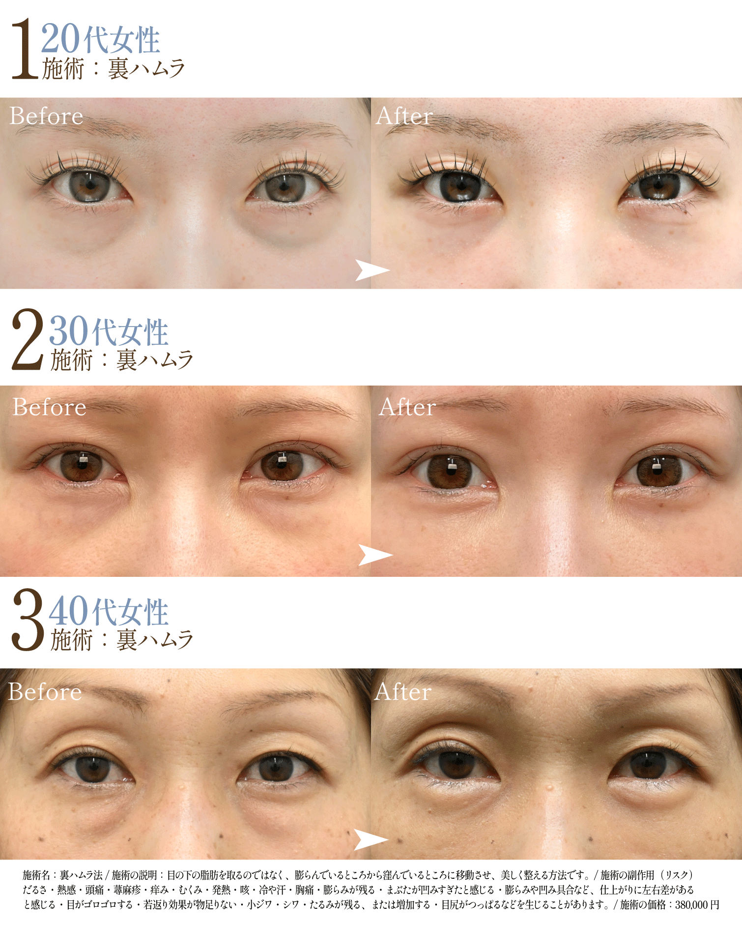 実際のクマ取り症例