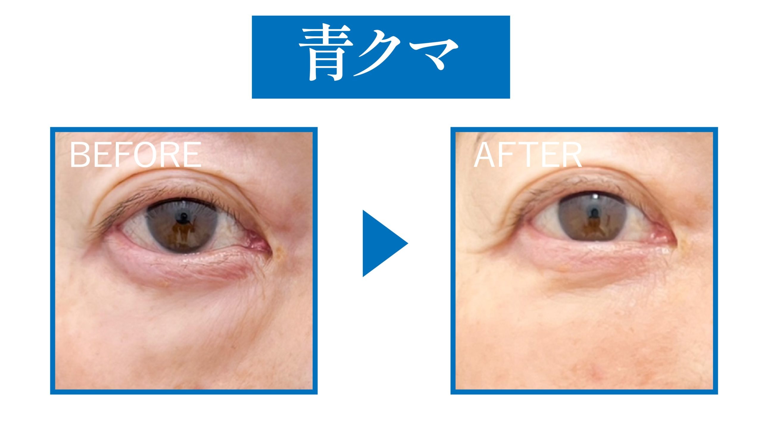 🟦青クマ｜血行不良による“疲れ顔”タイプ