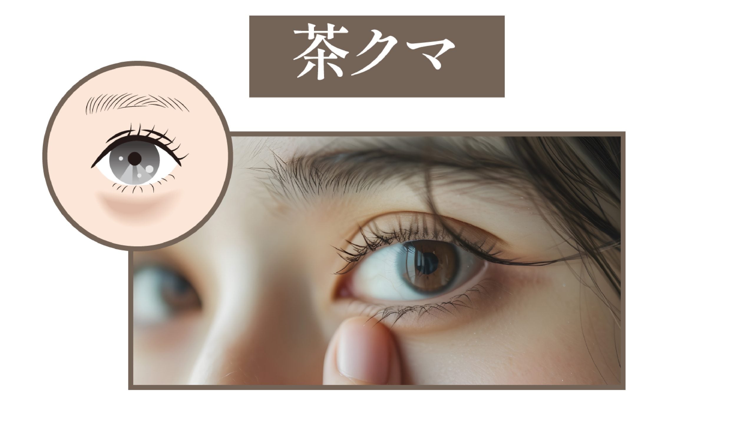 🟫茶クマ｜色素沈着による“くすみタイプ”
