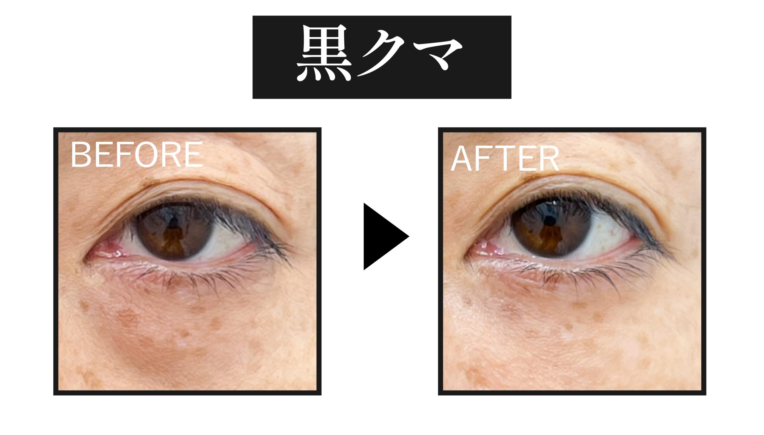 ⬛️黒クマ｜たるみや影による“老け見えタイプ”