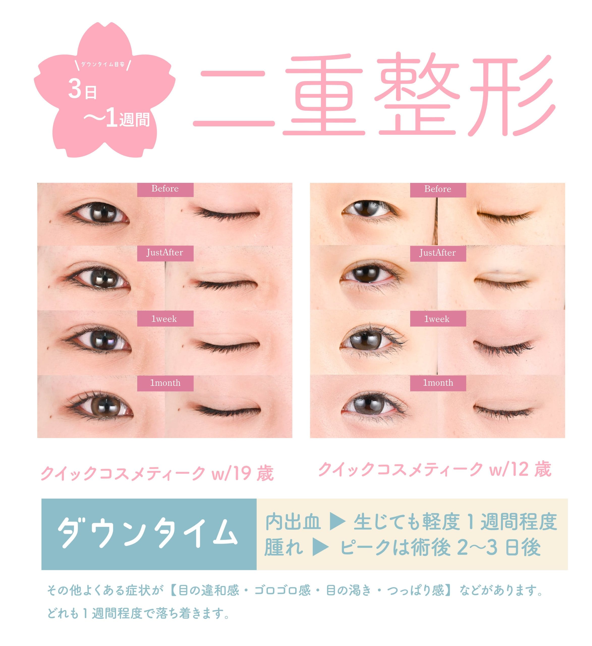 まずは王道👑二重整形